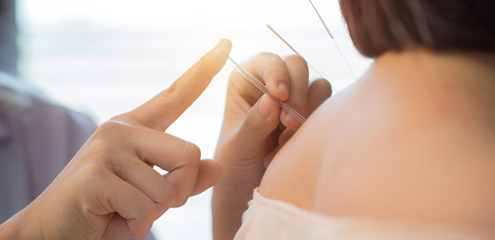 patient receiving acupuncture in Irvine for auto accident injury