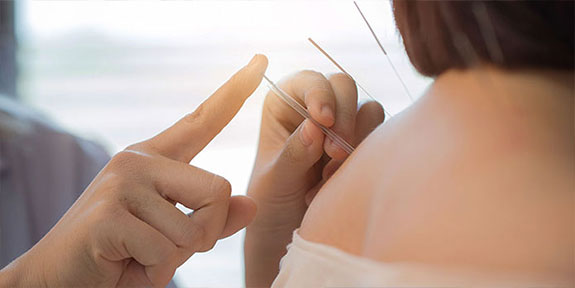 patient getting acupuncture in Irvine for auto accident injury