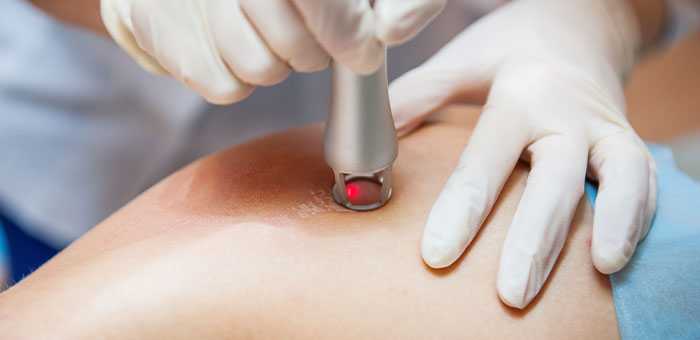 patient receiving cold laser therapy in Irvine for auto accident injury