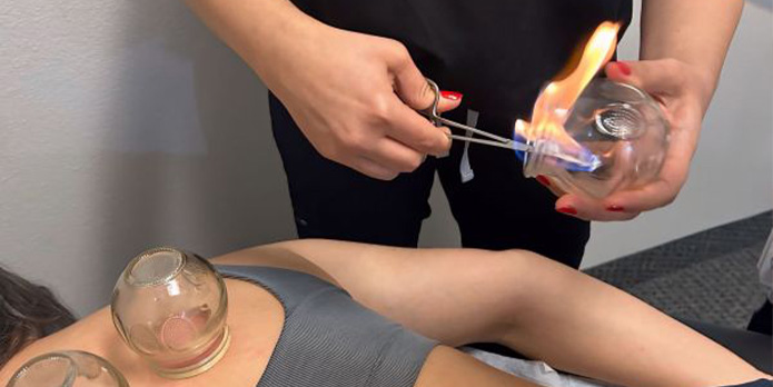 patient getting cupping therapy in Irvine for auto accident injury